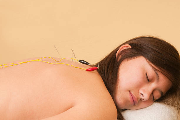 El akupunktur