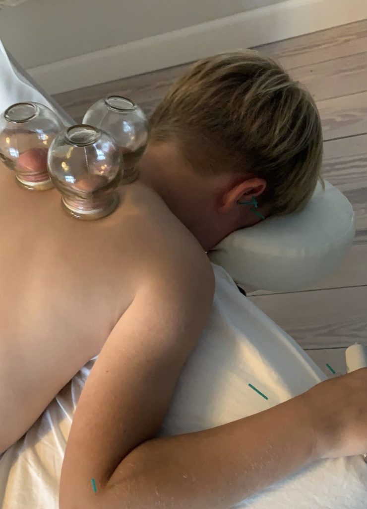 Akupunkturbehandling for forskellige diagnoser. Børnebehandling med cupping, akupunktur, akupressur, mellemørebetændelse, søvn, ADHD osv